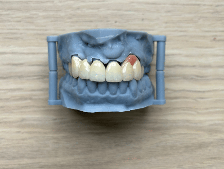 Le choix de la zircone multidureté